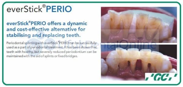 EverStick PERIO 1 x 8 cm