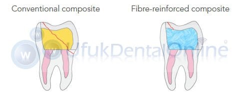 Everx Flow Bulk | Akıcı Fiber