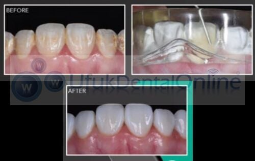 Exaclear Şeffaf Silikon Ölçü