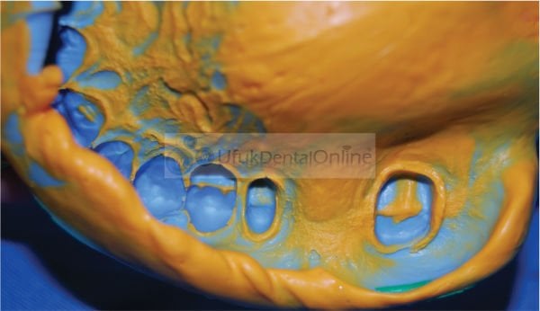 Flexceed A Silikon Ölçü Takım